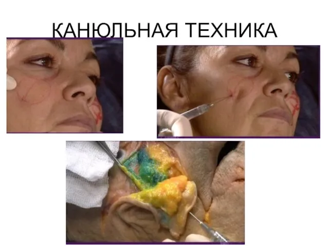 КАНЮЛЬНАЯ ТЕХНИКА