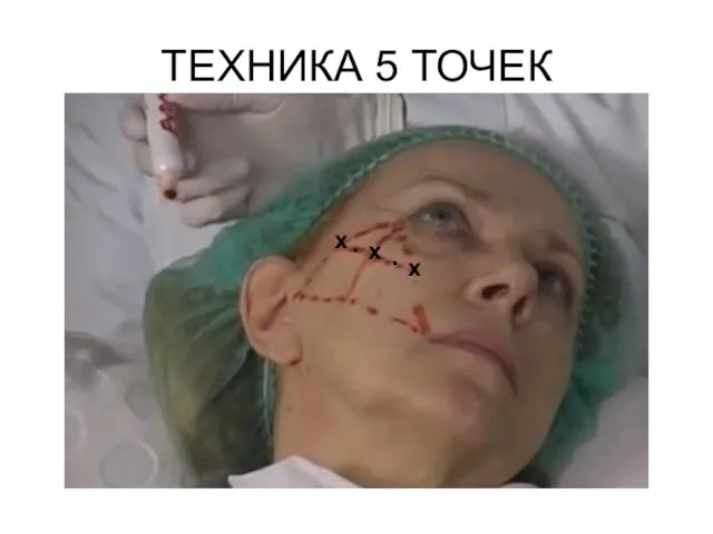 ТЕХНИКА 5 ТОЧЕК . х х . х