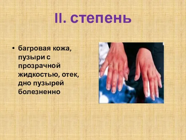 II. степень багровая кожа, пузыри с прозрачной жидкостью, отек, дно пузырей болезненно