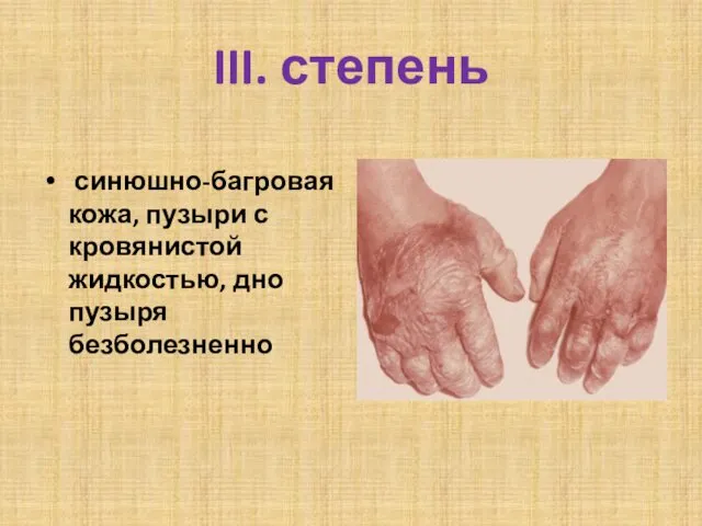 III. степень синюшно-багровая кожа, пузыри с кровянистой жидкостью, дно пузыря безболезненно