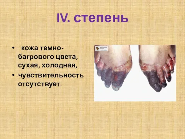 IV. степень кожа темно-багрового цвета, сухая, холодная, чувствительность отсутствует.