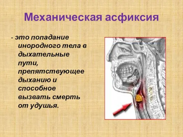 Механическая асфиксия - это попадание инородного тела в дыхательные пути,