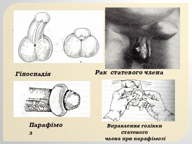 Гіпоспадія Рак статевого члена Парафімоз Вправлення голівки статевого члена при парафімозі