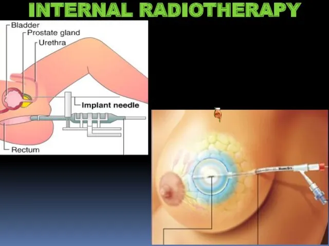 INTERNAL RADIOTHERAPY