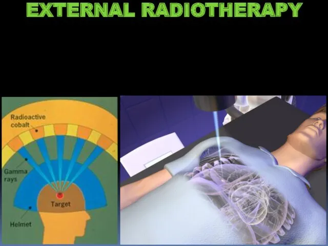 EXTERNAL RADIOTHERAPY