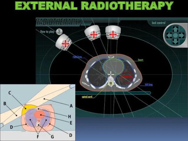 EXTERNAL RADIOTHERAPY