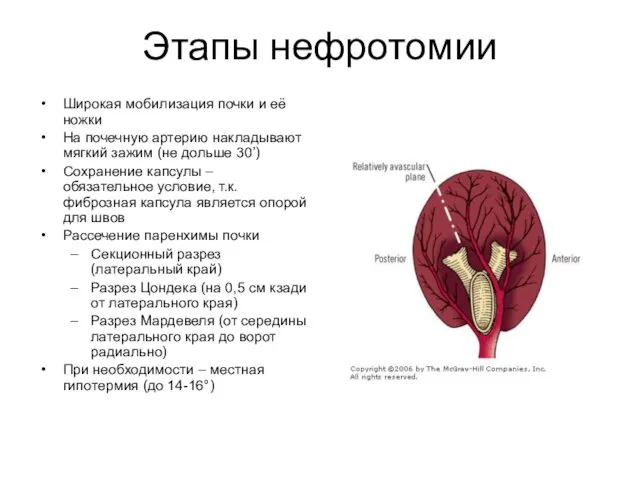 Этапы нефротомии Широкая мобилизация почки и её ножки На почечную