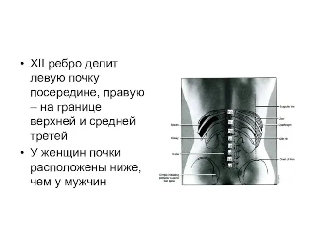 XII ребро делит левую почку посередине, правую – на границе