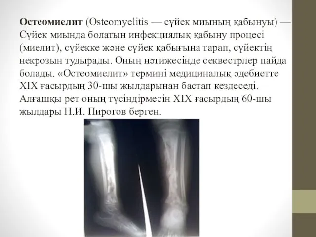 Остеомиелит (Osteomyelitis — сүйек миының қабынуы) — Сүйек миында болатын