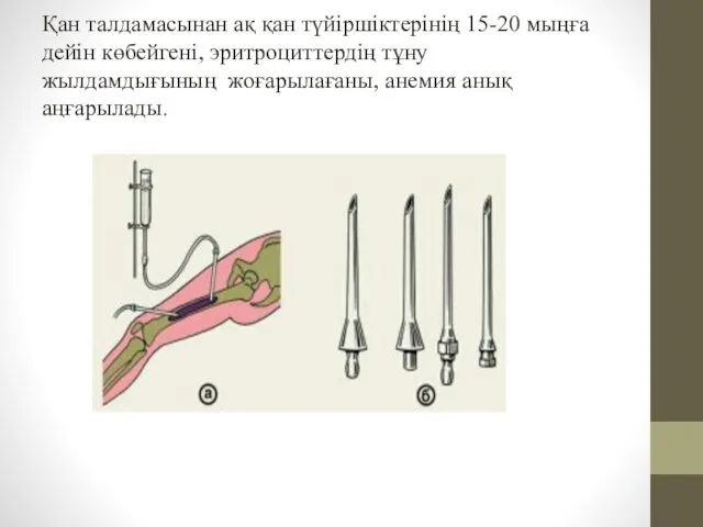 Қан талдамасынан ақ қан түйiршiктерiнiң 15-20 мыңға дейiн көбейгенi, эритроциттердің тұну жылдамдығының жоғарылағаны, анемия анық аңғарылады.