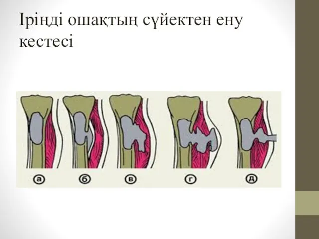 Іріңді ошақтың сүйектен ену кестесі