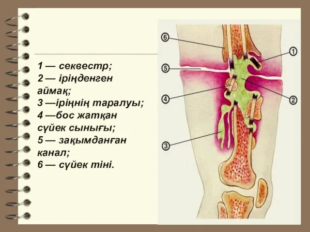 1 — секвестр; 2 — іріңденген аймақ; 3 —іріңнің таралуы; 4 —бос жатқан