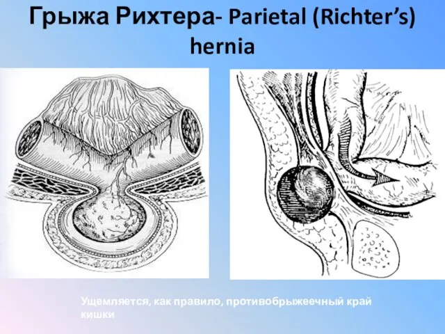 Грыжа Рихтера- Parietal (Richter’s) hernia Ущемляется, как правило, противобрыжеечный край кишки