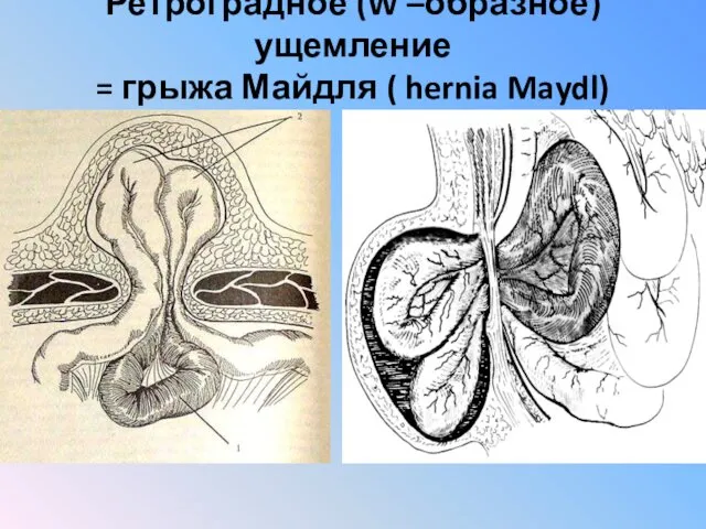 Ретроградное (W –образное) ущемление = грыжа Майдля ( hernia Maydl)