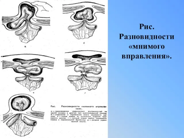 Рис. Разновидности «мнимого вправления».