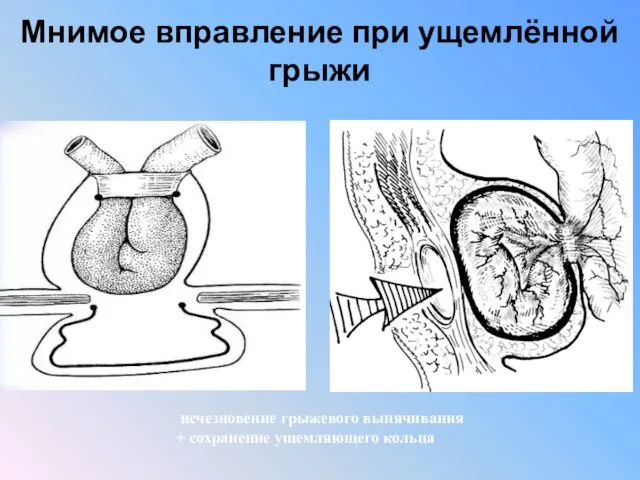 Мнимое вправление при ущемлённой грыжи исчезновение грыжевого выпячивания + сохранение ущемляющего кольца