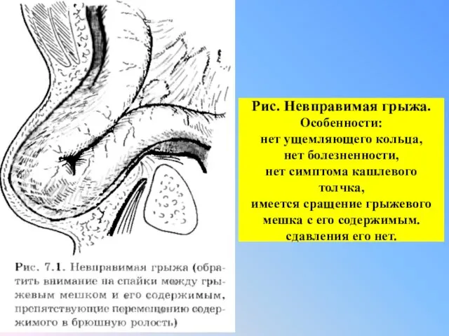 Рис. Невправимая грыжа. Особенности: нет ущемляющего кольца, нет болезненности, нет симптома кашлевого толчка,