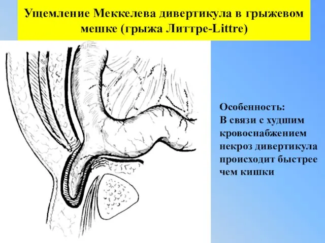 Ущемление Меккелева дивертикула в грыжевом мешке (грыжа Литтре-Littre) Особенность: В связи с худшим