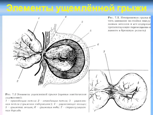 Элементы ущемлённой грыжи