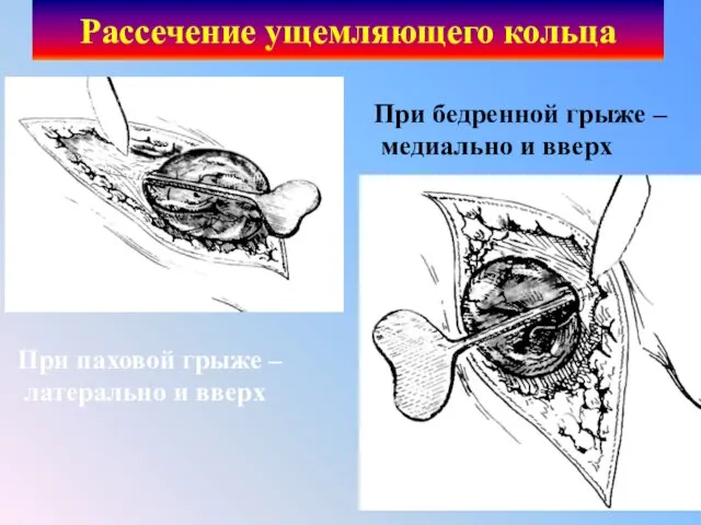 Рассечение ущемляющего кольца При паховой грыже – латерально и вверх При бедренной грыже