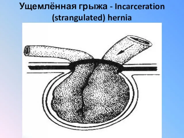 Ущемлённая грыжа - Incarceration (strangulated) hernia