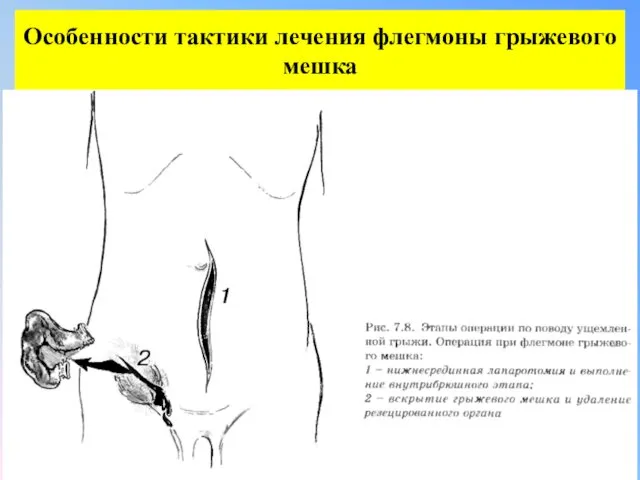 Особенности тактики лечения флегмоны грыжевого мешка