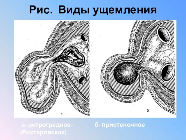 Рис. Виды ущемления а- ретроградное- б- пристеночное (Рихтеровское) W-образное