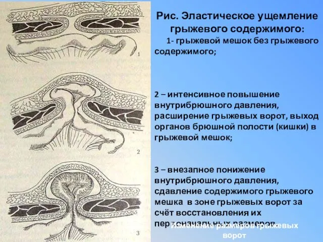 Рис. Эластическое ущемление грыжевого содержимого: 1- грыжевой мешок без грыжевого содержимого; 2 –