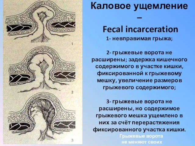 Каловое ущемление – Fecal incarceration 1- невправимая грыжа; 2- грыжевые ворота не расширены;