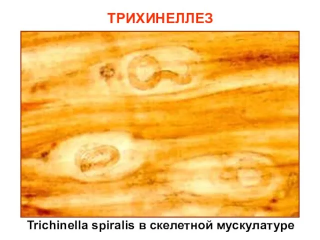 ТРИХИНЕЛЛЕЗ Trichinella spiralis в скелетной мускулатуре