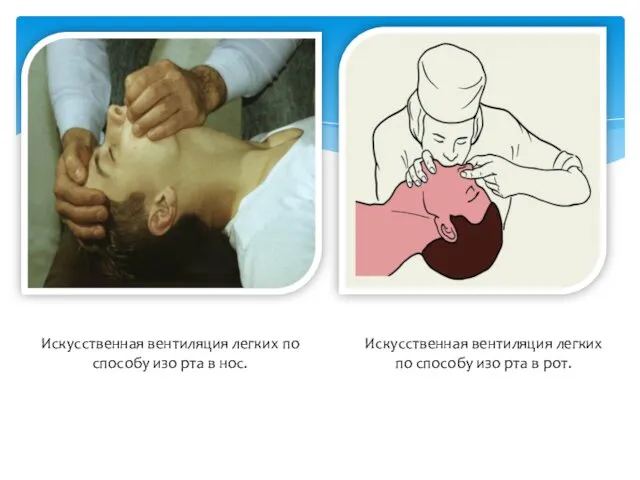Искусственная вентиляция легких по способу изо рта в нос. Искусственная