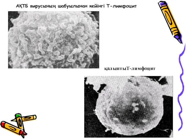 АҚТБ вирусының шабуылынан кейінгі Т-лимфоцит қалыптыТ-лимфоцит