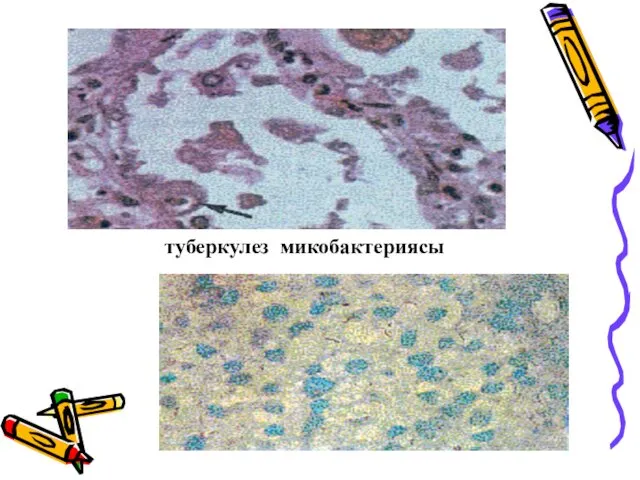 Цитомегаловирус туберкулез микобактериясы