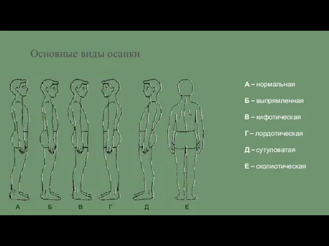 Основные виды осанки А Б В Г Д Е А – нормальная Б