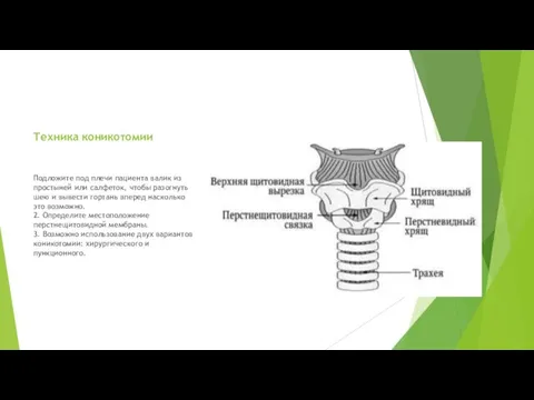 Техника коникотомии Подложите под плечи пациента валик из простыней или