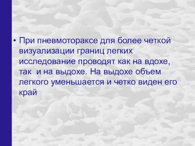 При пневмотораксе для более четкой визуализации границ легких исследование проводят как на вдохе,