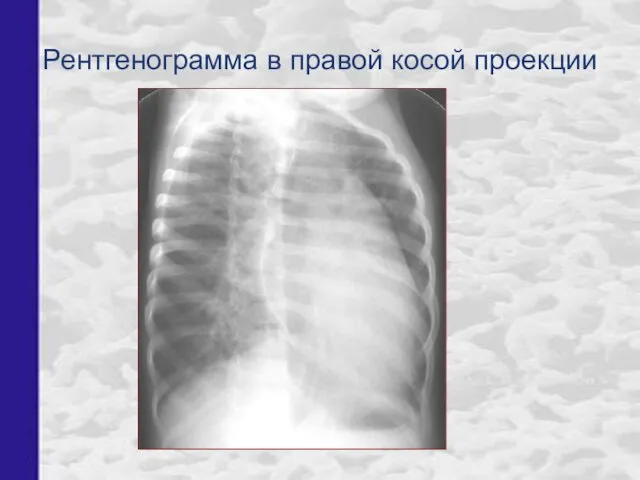 Рентгенограмма в правой косой проекции