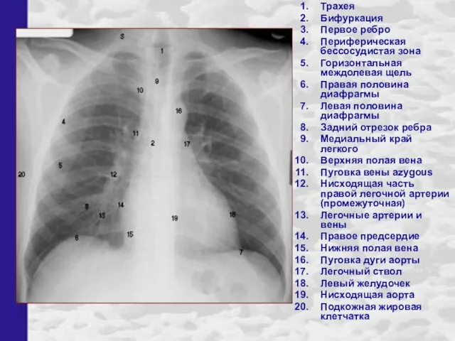 Трахея Бифуркация Первое ребро Периферическая бессосудистая зона Горизонтальная междолевая щель