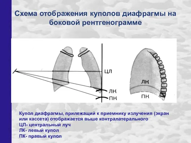 Схема отображения куполов диафрагмы на боковой рентгенограмме Купол диафрагмы, прилежащий