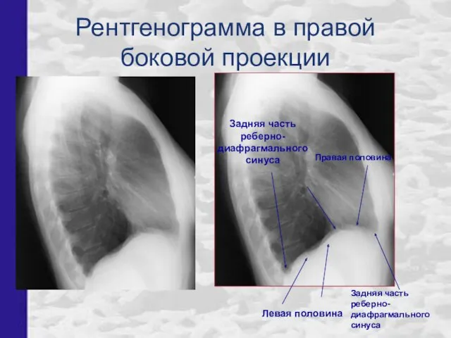 Рентгенограмма в правой боковой проекции Левая половина Правая половина Задняя часть реберно- диафрагмального