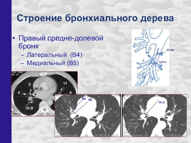 Правый средне-долевой бронх Латеральный (В4) Медиальный (В5) В5 В4 MLB 1,5см Строение бронхиального дерева 25 мм