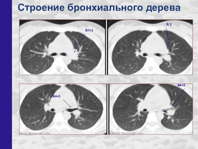 Строение бронхиального дерева В1+2 В4+5 В 3 В4+5