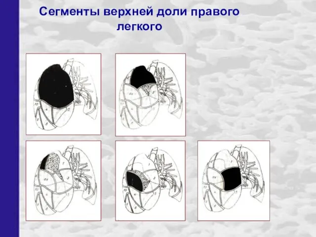 Сегменты верхней доли правого легкого