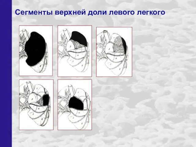 Сегменты верхней доли левого легкого