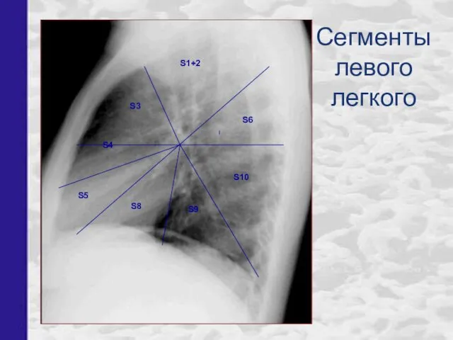 Сегменты левого легкого S1+2 S3 S4 S8 S5 S9 S6 S10