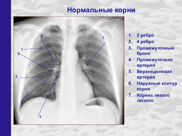 2 ребро 4 ребро Промежуточный бронх Промежуточная артерия Верхнедолевая артерия