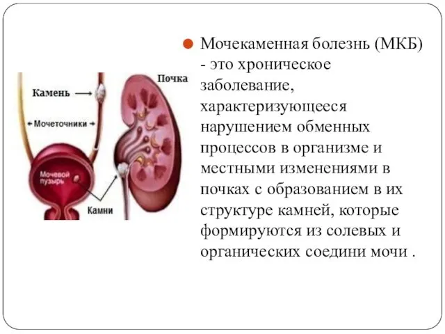 Мочекаменная болезнь (МКБ) - это хроническое заболевание, характеризующееся нарушением обменных