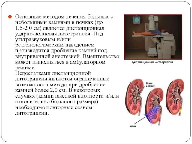 Основным методом лечения больных с небольшими камнями в почках (до