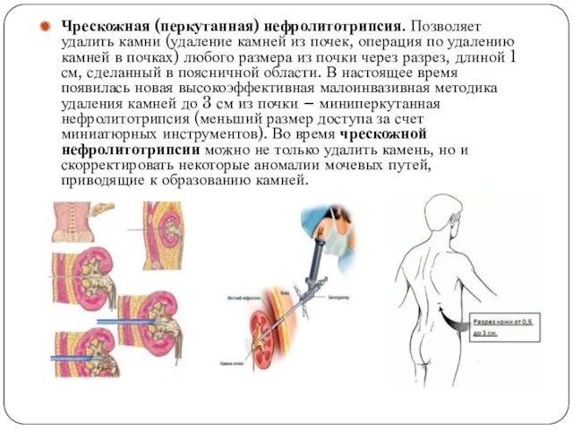 Чрескожная (перкутанная) нефролитотрипсия. Позволяет удалить камни (удаление камней из почек,