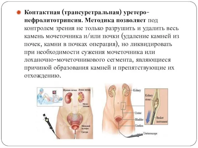 Контактная (трансуретральная) уретеро- нефролитотрипсия. Методика позволяет под контролем зрения не только разрушить и